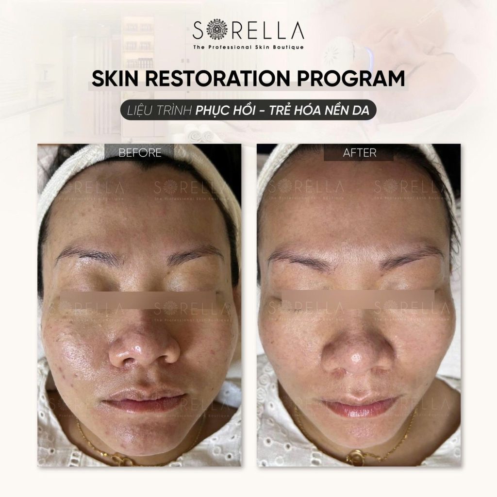 Before and after: Skin Restoration Program at Sorella