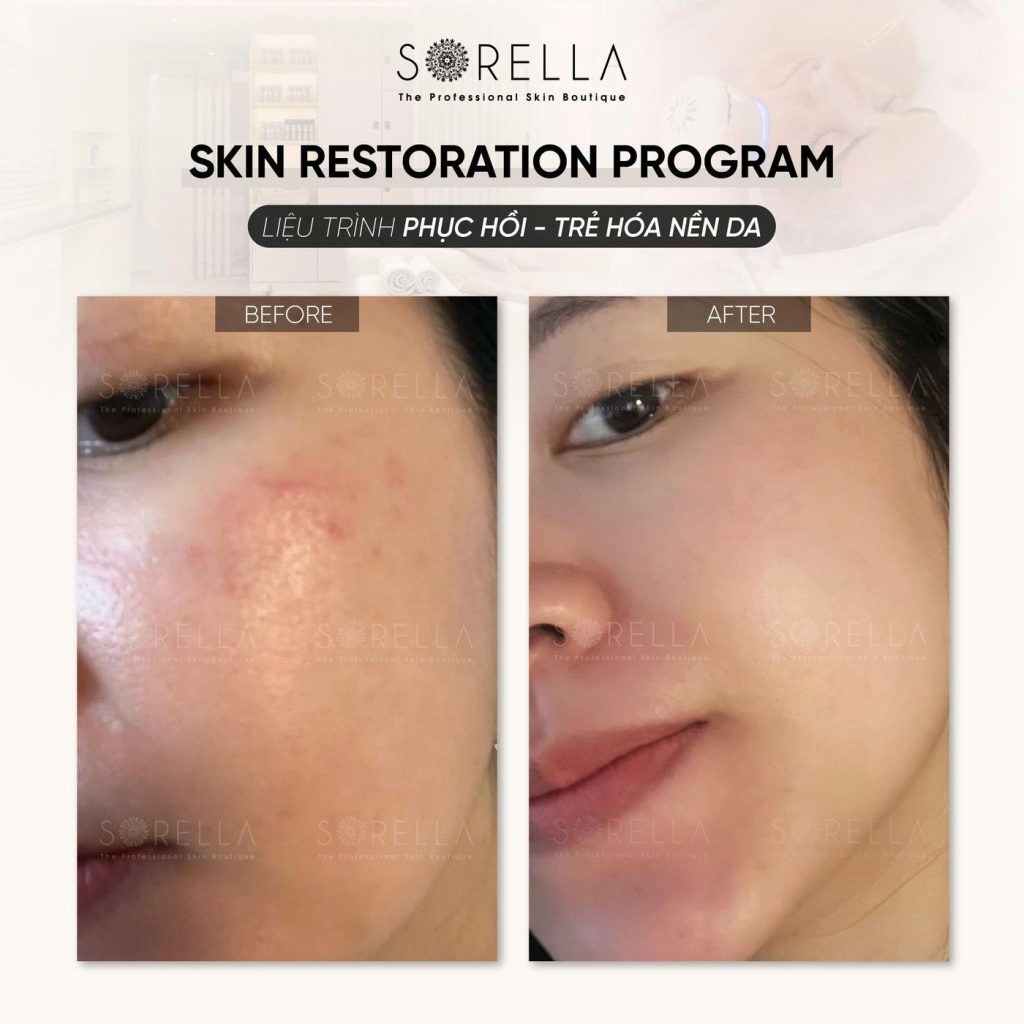 Before and after: Skin Restoration Program at Sorella
