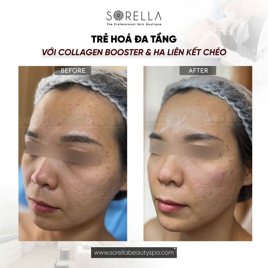 Before and after: Trẻ hoá đa tầng với Collagen Booster & HA liên kết chéo at Sorella