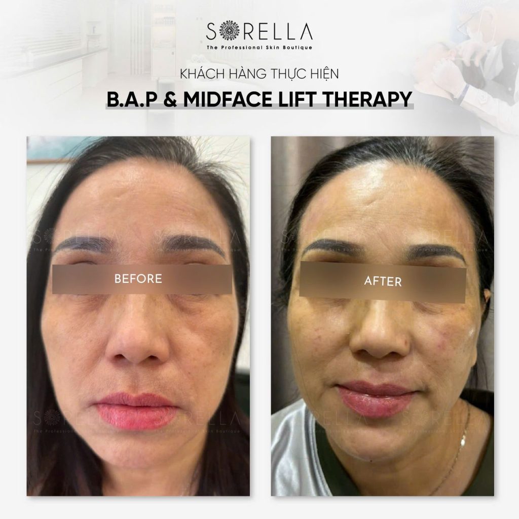 Before and after: B.A.P & Midface Lift Therapy at Sorella