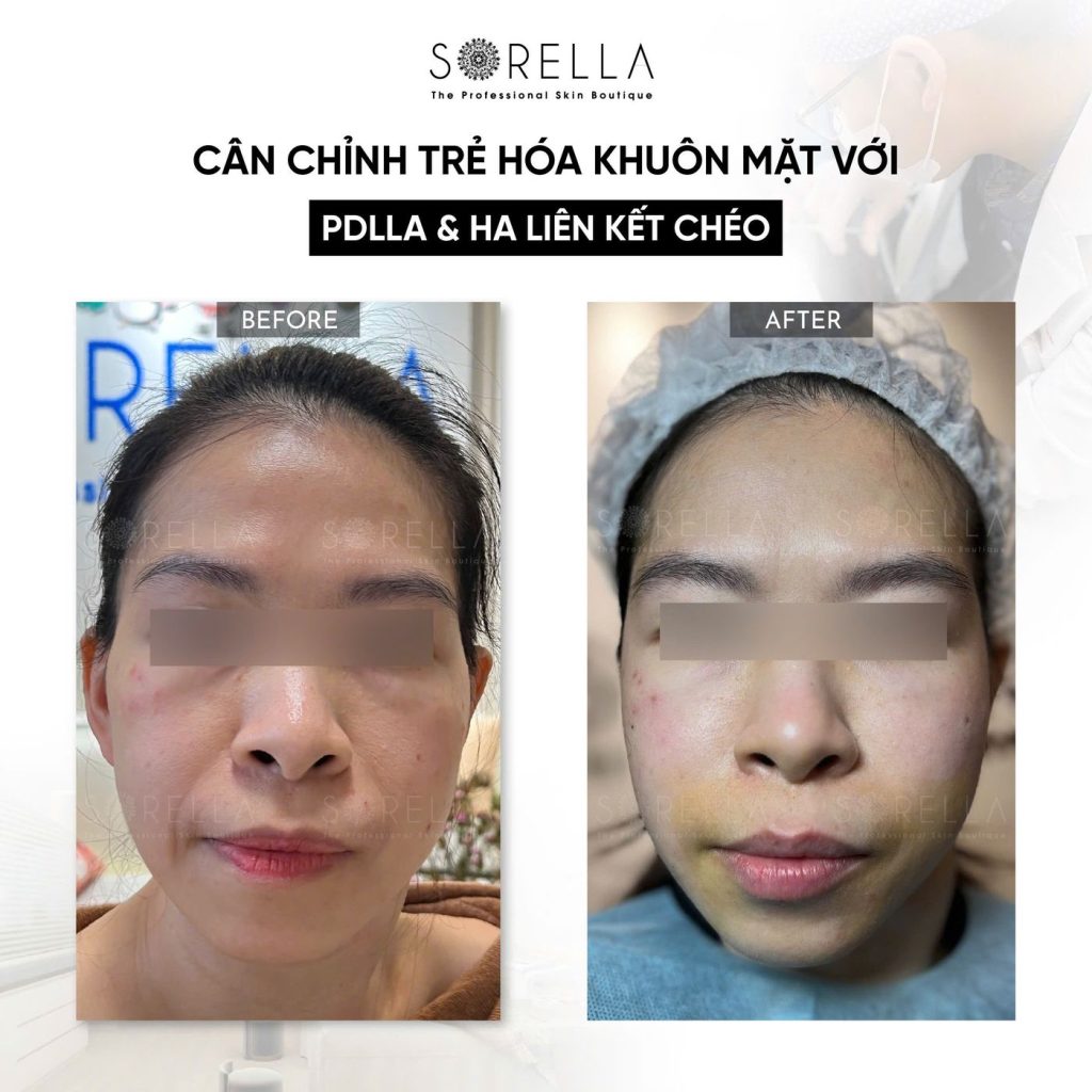 Before and after: Cân chỉnh trẻ hoá với PDLLA & HA liên kết chéo at Sorella