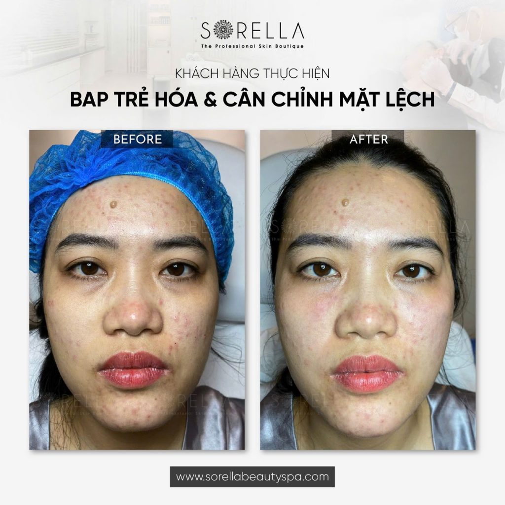 Before and after: BAP trẻ hoá & cân chỉnh mặt lệch at Sorella