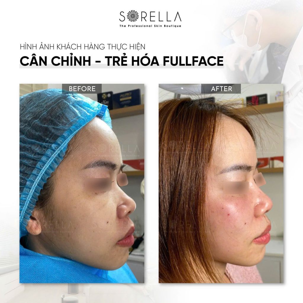 Before and after: Cân chỉnh – trẻ hoá fullface at Sorella