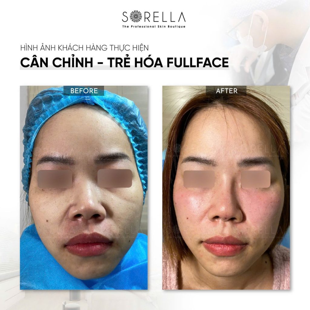 Before and after: Cân chỉnh – trẻ hoá fullface at Sorella