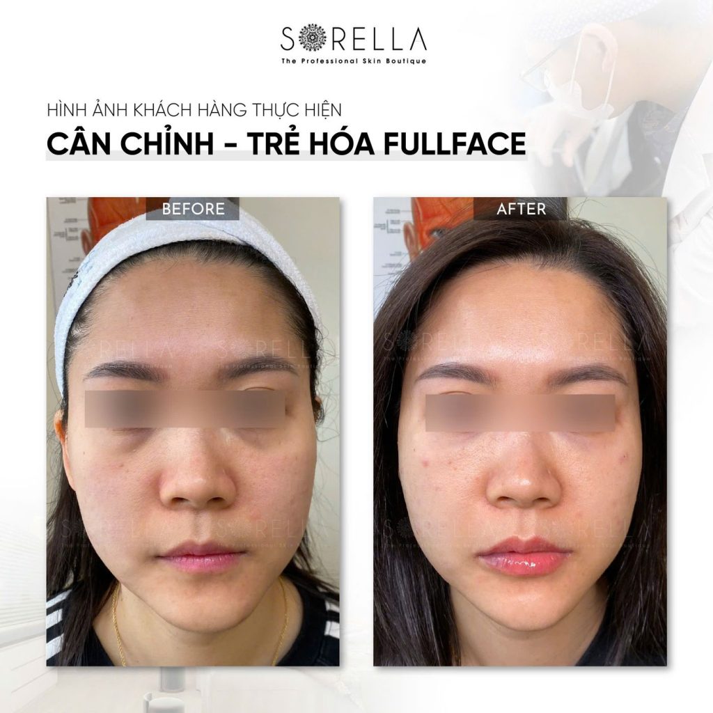 Before and after: Cân chỉnh – trẻ hoá fullface at Sorella