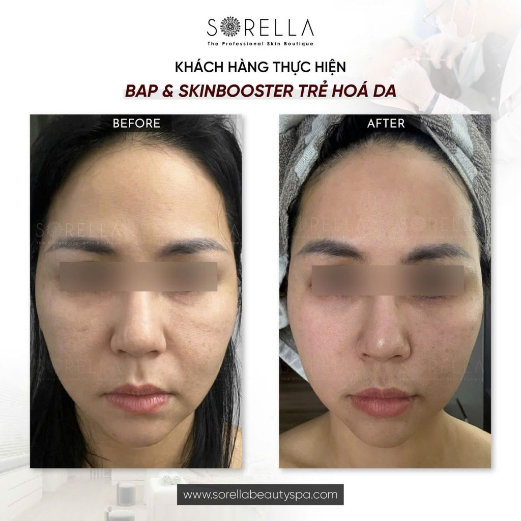 Before and after: BAP & Skinbooster trẻ hoá da at Sorella