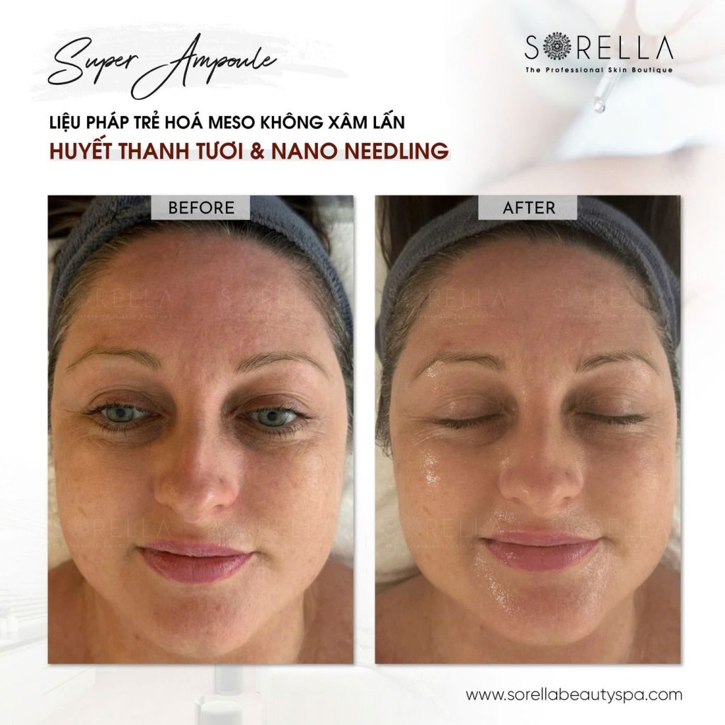 Before and after: Super Ampoule at Sorella