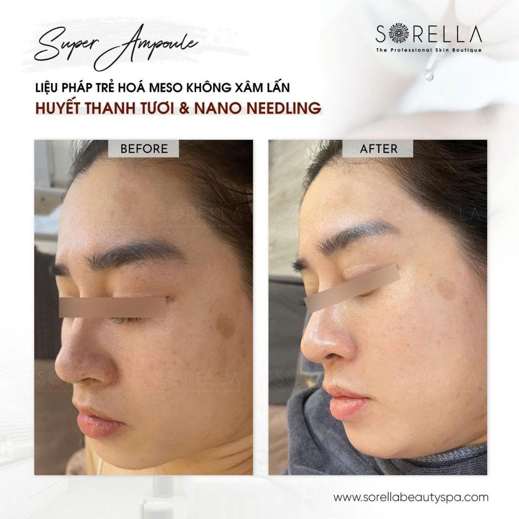 Before and after: Super Ampoule at Sorella