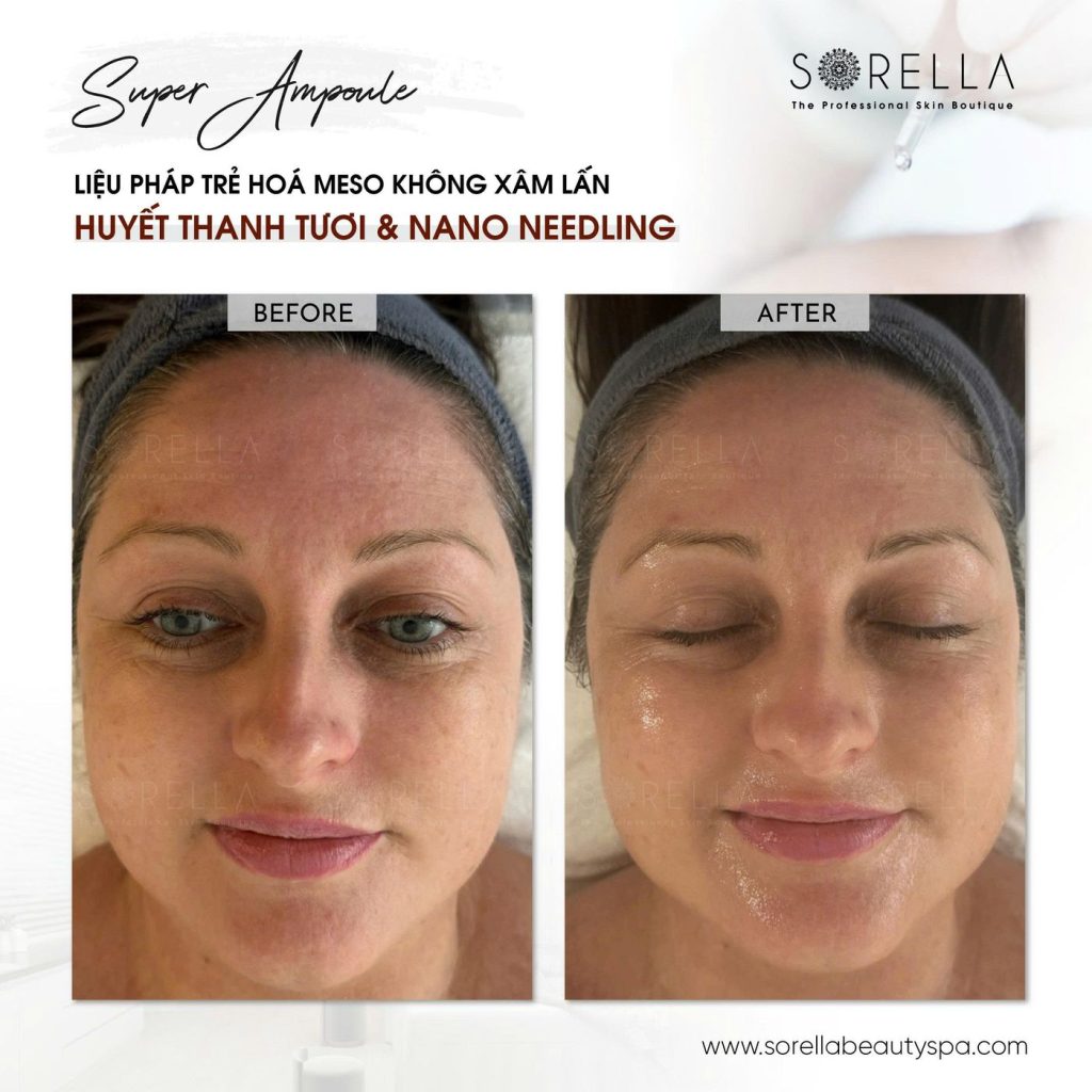 Before and after: Super Ampoule at Sorella