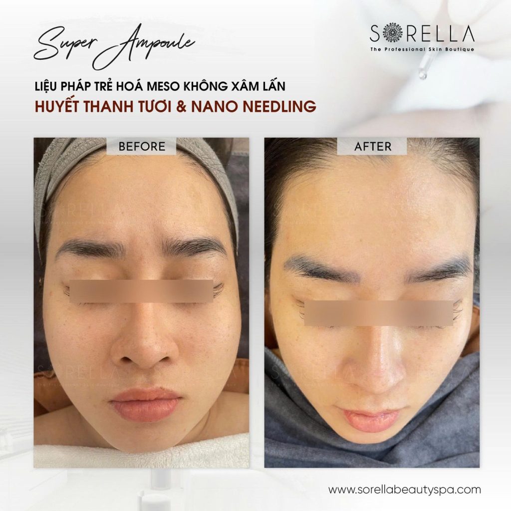 Before and after: Super Ampoule at Sorella