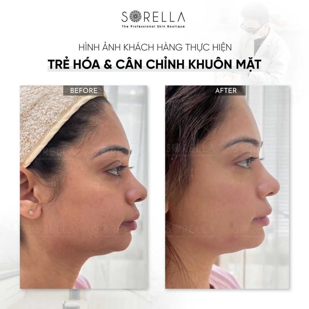 Before and after: Trẻ hoá & cân chỉnh khuôn mặt at Sorella