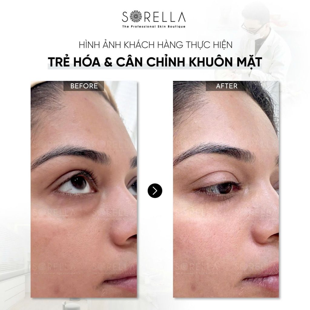 Before and after: Trẻ hoá & cân chỉnh khuôn mặt at Sorella