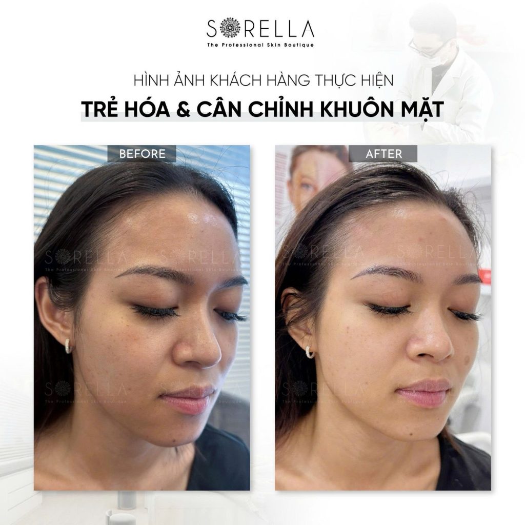 Before and after: Trẻ hoá & cân chỉnh khuôn mặt at Sorella