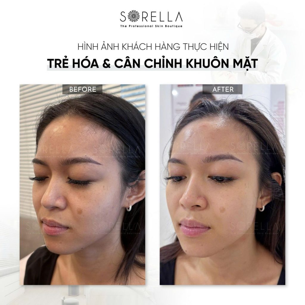 Before and after: Trẻ hoá & cân chỉnh khuôn mặt at Sorella