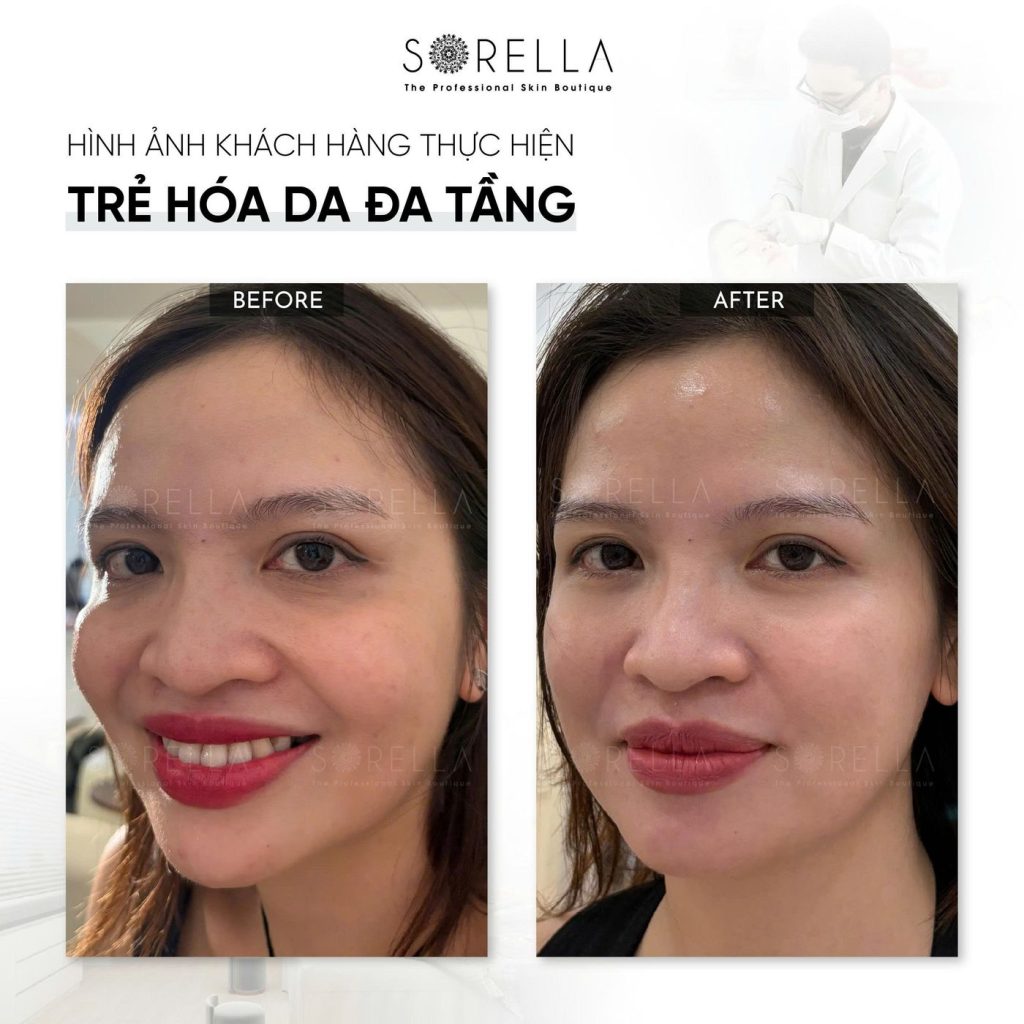 Before and after: Trẻ hoá da đa tầng at Sorella