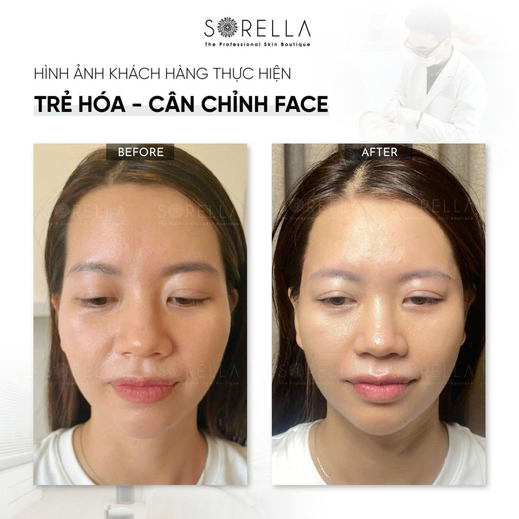Before and after: Trẻ hoá – cân chỉnh face at Sorella