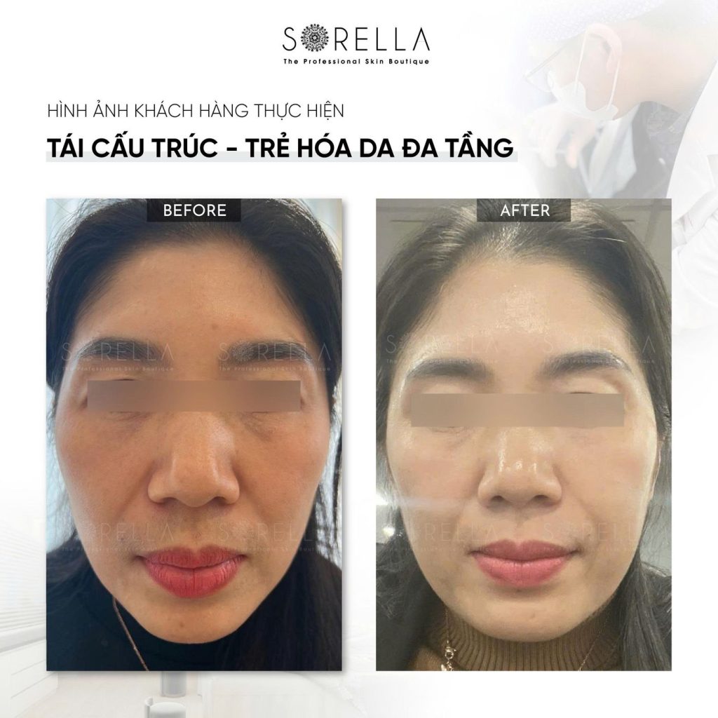 Before and after: Tái cấu trúc – trẻ hoá da đa tầng at Sorella