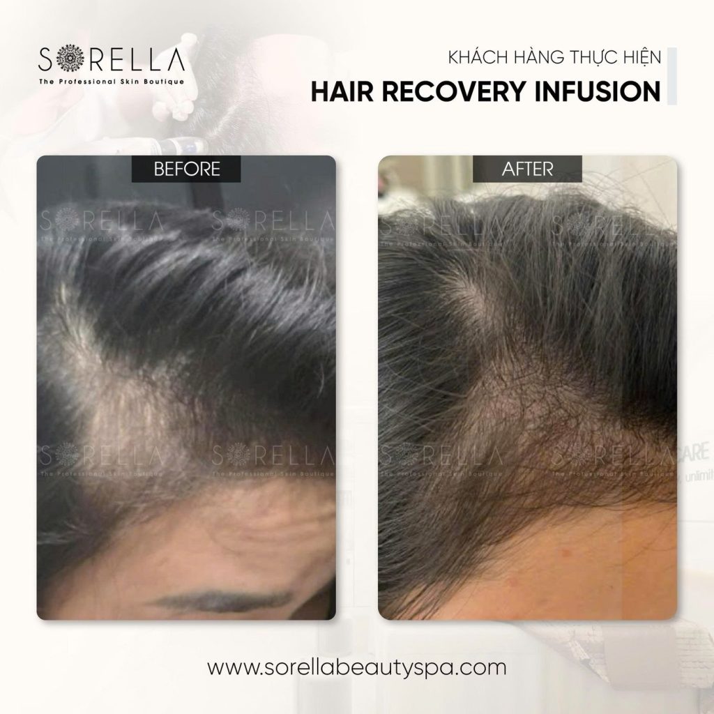 Before and after: Hair Recovery Infusion at Sorella