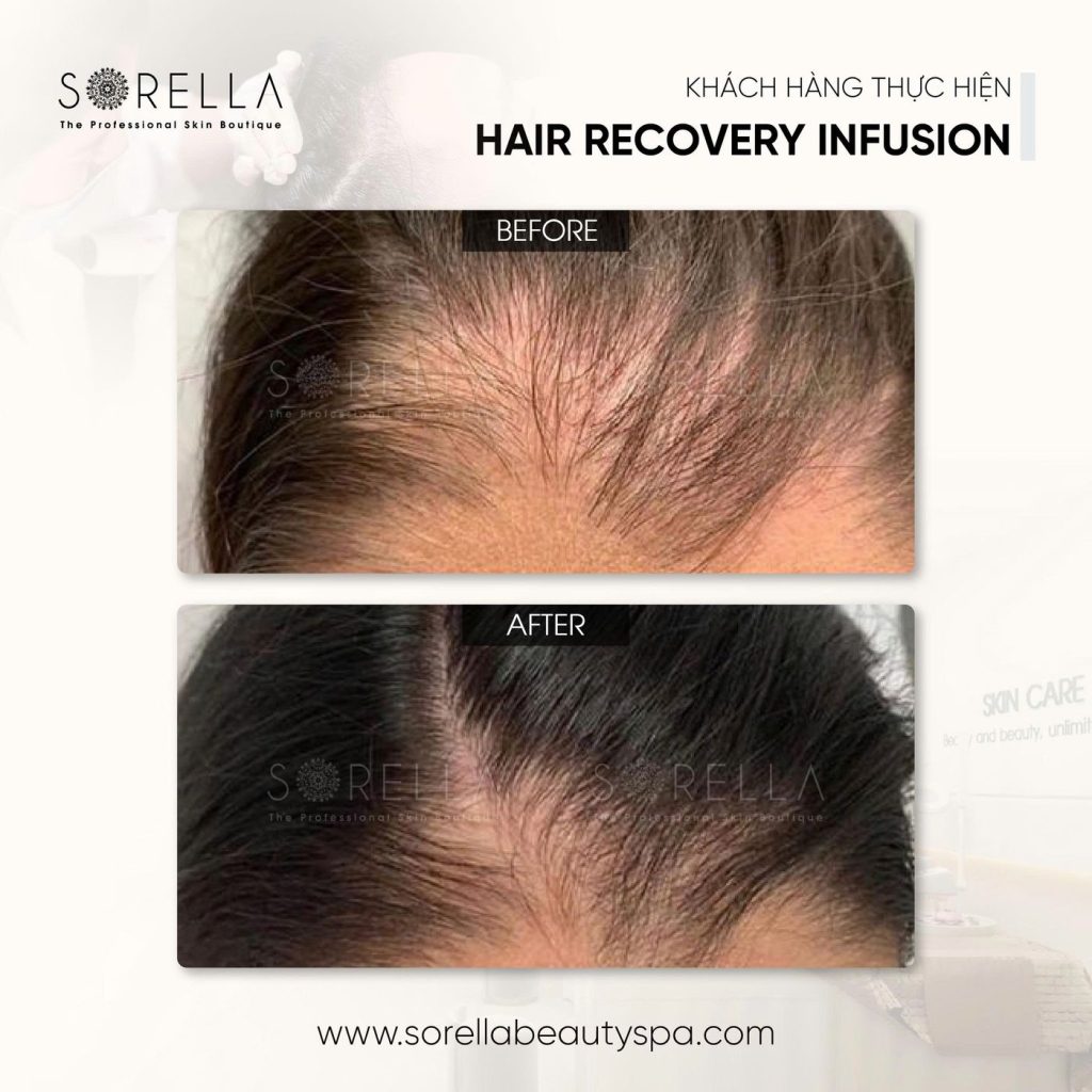 Before and after: Hair Recovery Infusion at Sorella