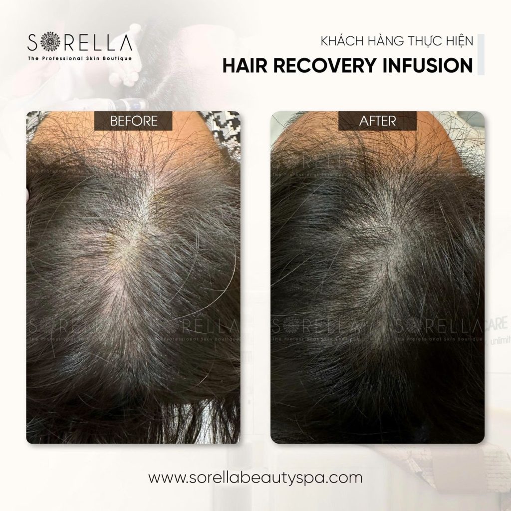 Before and after: Hair Recovery Infusion at Sorella
