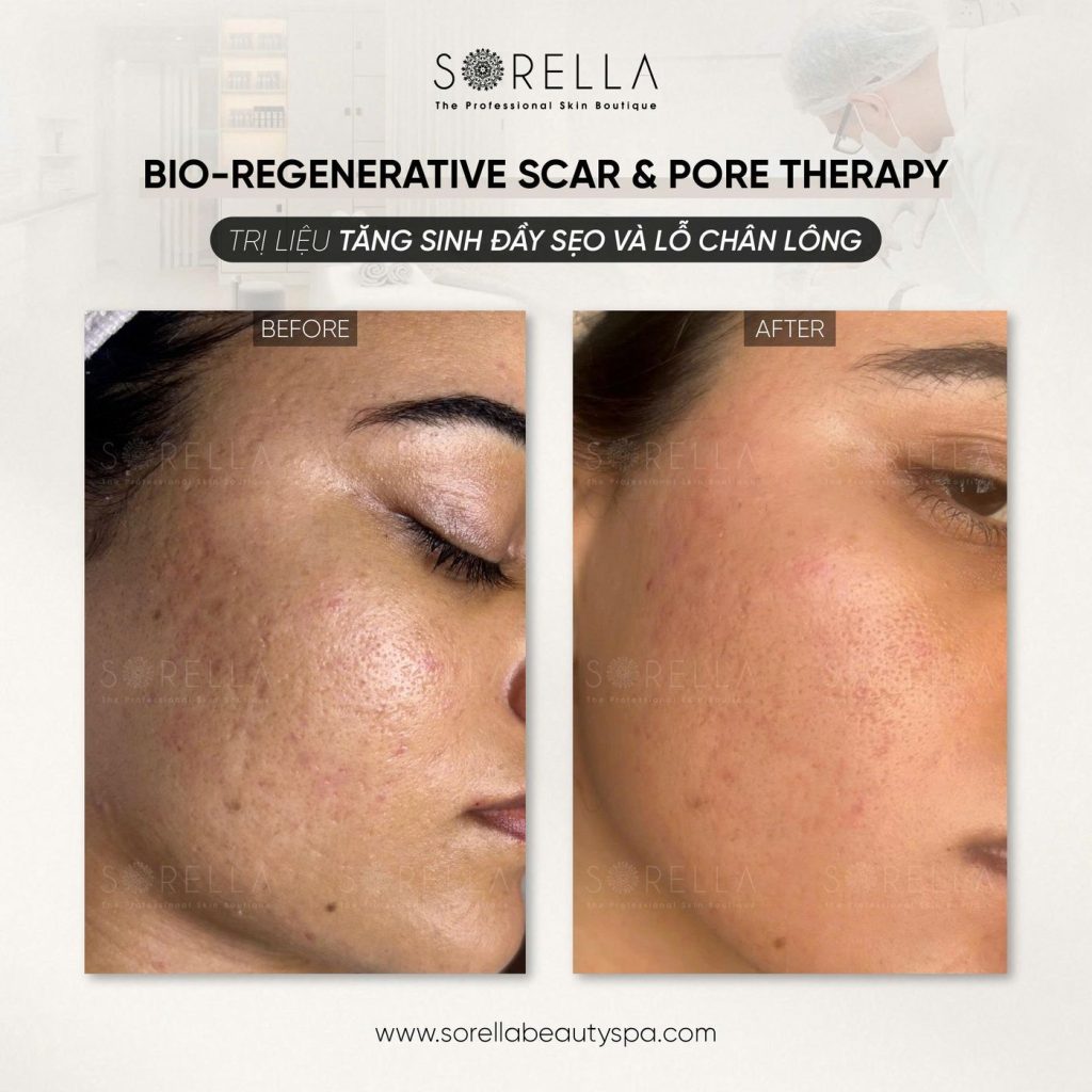 Before and after: Bio-regenerative Scar & Pore Therapy at Sorella