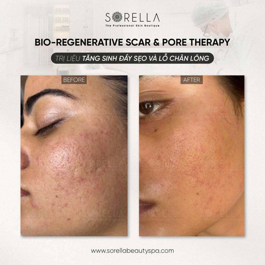 Before and after: Bio-regenerative Scar & Pore Therapy at Sorella