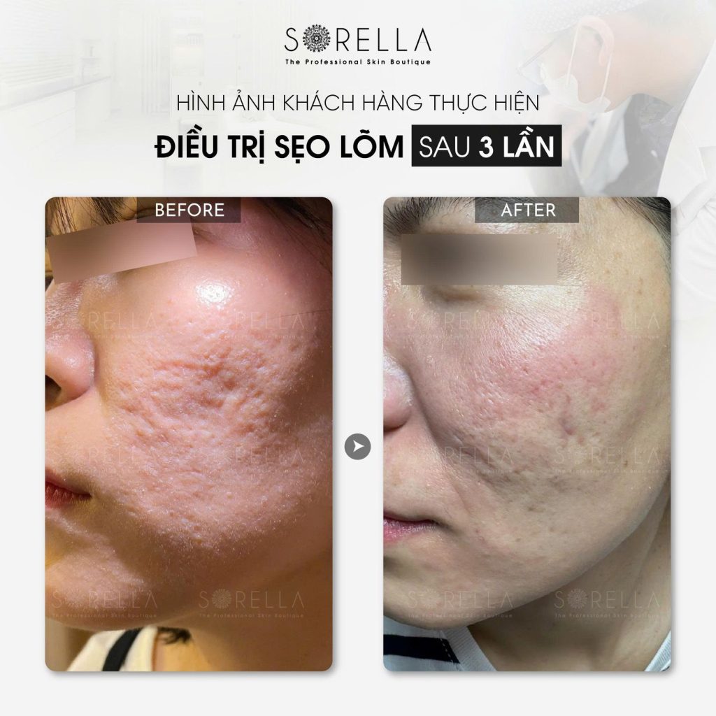 Before and after: Điều trị sẹo lõm at Sorella