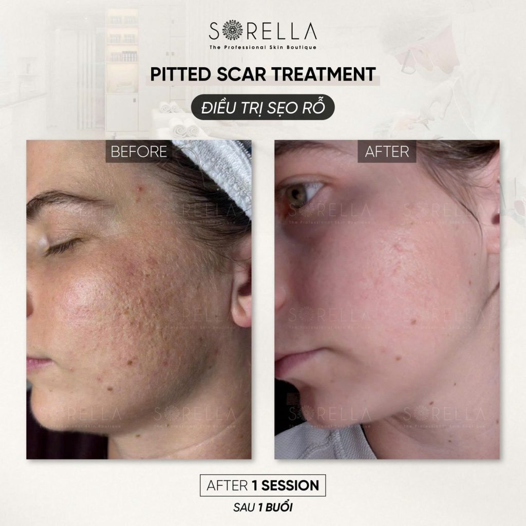 Before and after: Pitted Scar Treatment at Sorella