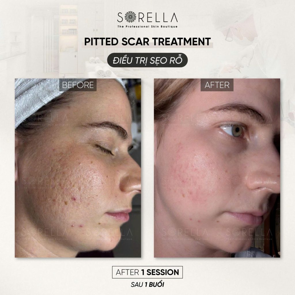 Before and after: Pitted Scar Treatment at Sorella