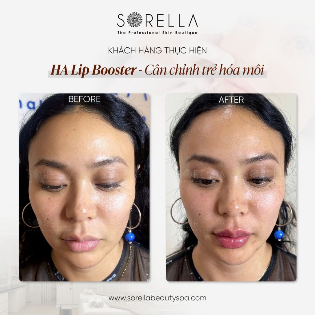 Before and after: HA Lip Booster at Sorella