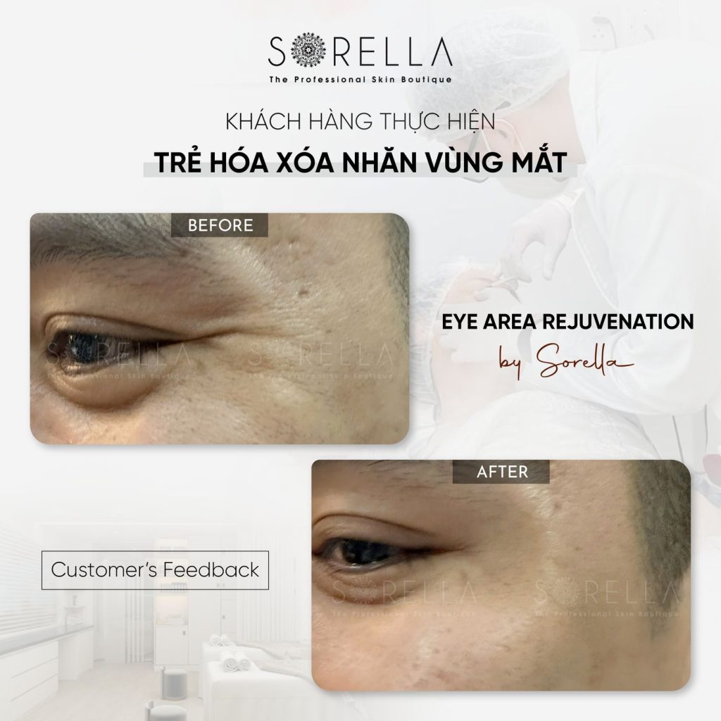 Before and after: Trẻ hoá xoá nhăn vùng mắt at Sorella