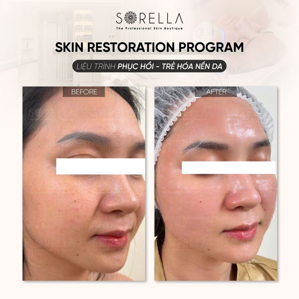 Before and after: Skin Restoration Program at Sorella