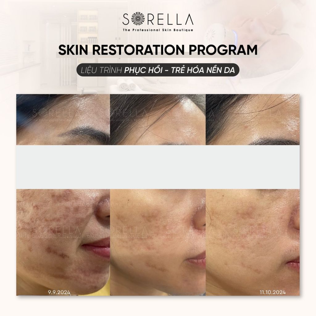 Before and after: Skin Restoration Program at Sorella