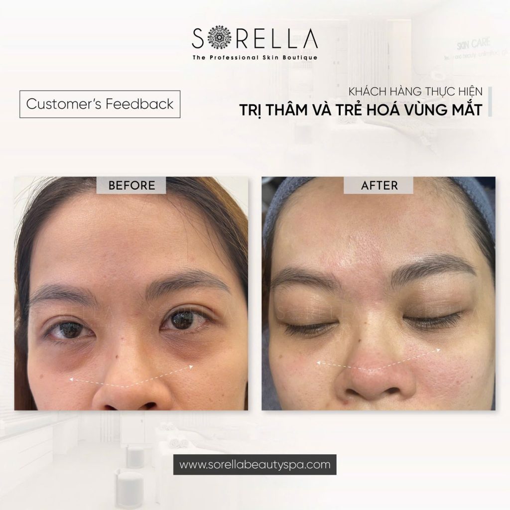 Before and after: Trị thâm & trẻ hoá vùng mắt at Sorella