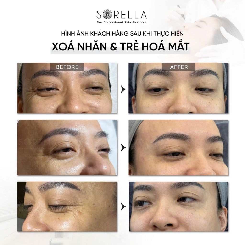 Before and after: Xoá nhăn & trẻ hoá mắt at Sorella
