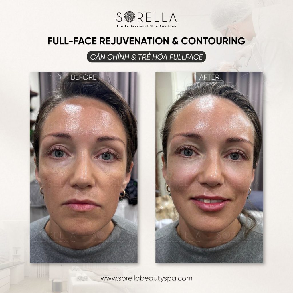 Before and after: Full-face Rejuvenation & Contouring at Sorella