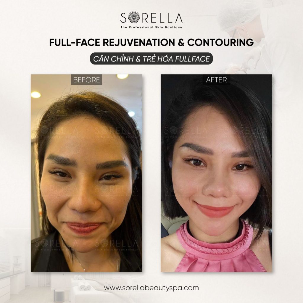 Before and after: Full-face Rejuvenation & Contouring at Sorella