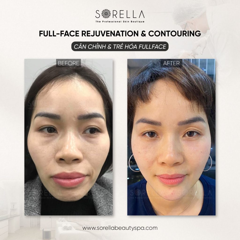 Before and after: Full-face Rejuvenation & Contouring at Sorella